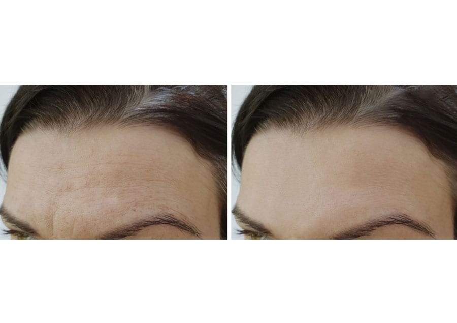 before-after-results-of-endoscopic-forehead-lift
