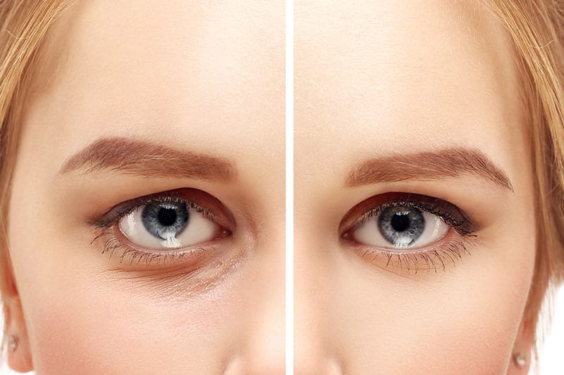 lower-eyelid-lift-results-allure-aesthetic-of-beverly-hills