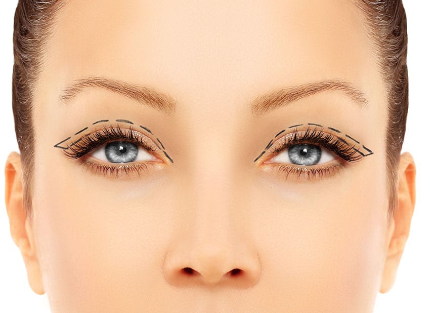 potential-adjustments-for-upper-eyelid-lift-allure-aesthetic-of-beverly-hills