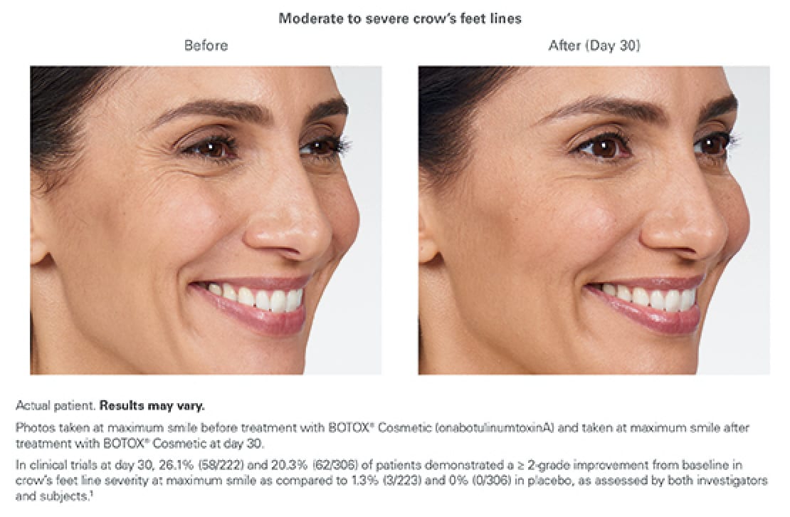 alexandra-botox-moderate-to-severe-crows-feet-lines-allure-aesthetic-of-beverly-hills-1