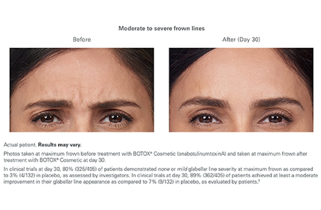 alexandra-botox-moderate-to-severe-frown-lines-allure-aesthetic-of-beverly-hills-1