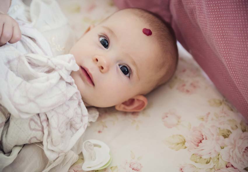 baby-with-hemangioma-allure-aesthetic-of-beverly-hills