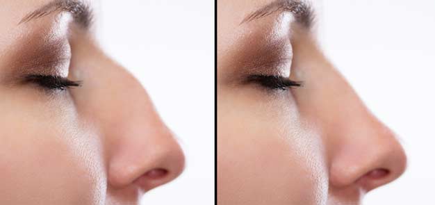 beverly-hills-rhinoplasty-specialist-allure-aesthetic-of-beverly-hills
