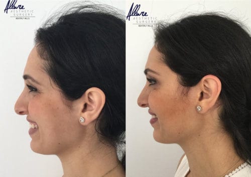 Botox – Before and After