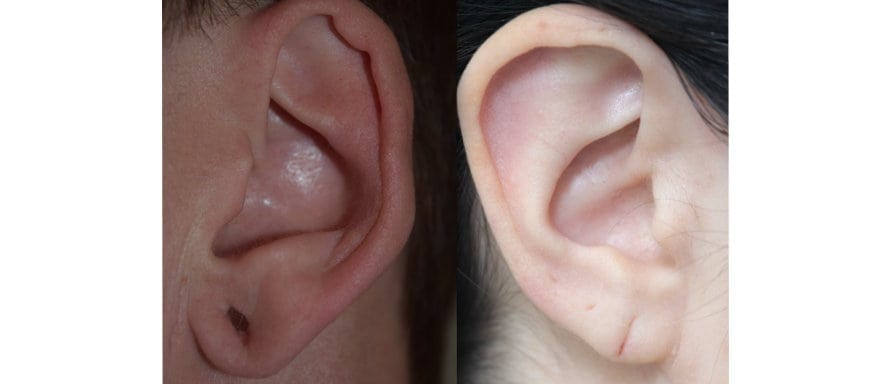 Is Earlobe Repair Right For You?