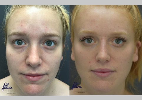 Dermal Fillers – Before and After
