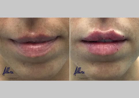 Non-Surgical Lip Augmentation – Before and After