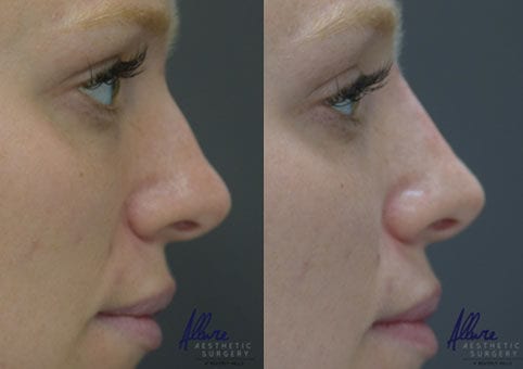Non-Surgical Rhinoplasty – Before and After
