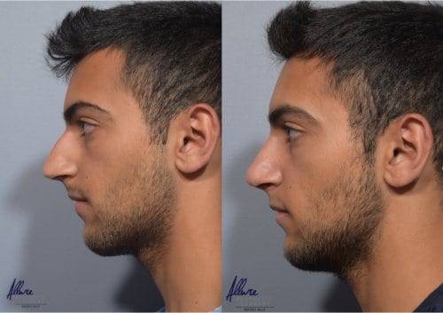 rhinoplasty-before-after