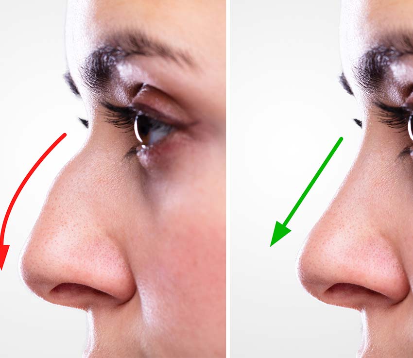 top-rhinoplasty-surgeon-in-beverly-hills-allure-aesthetic-of-beverly-hills-3