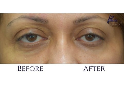 Under-Eye Rejuvenation – Before and After