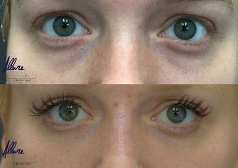Under-Eye Rejuvenation – Before and After