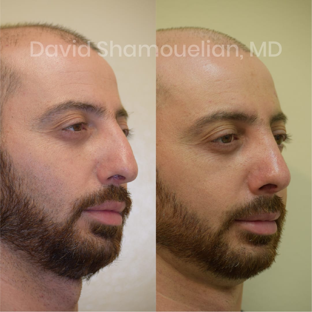 patient-14-before-after