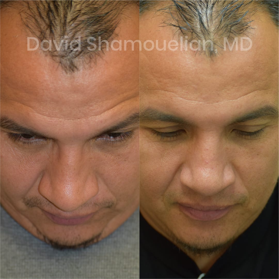 patient-13-before-after