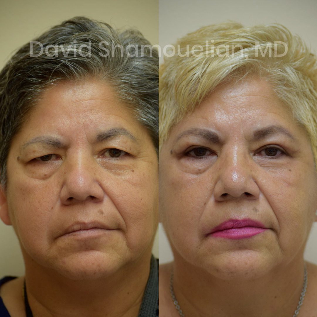Allure BH Brow Lift with Upper Eyelid Blepharoplasty Before After
