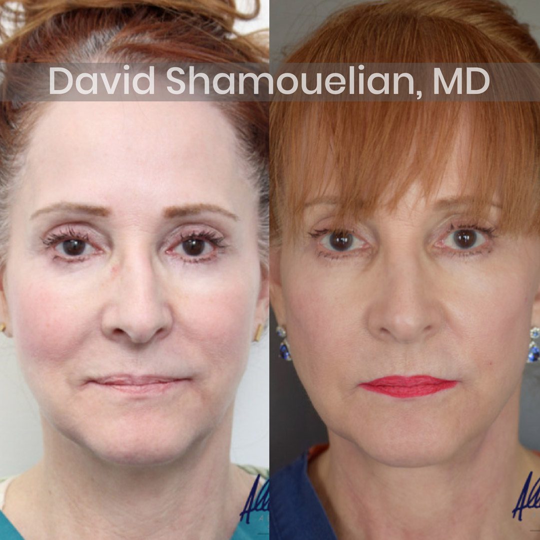 Allure-BH-Face-and-Neck-Lift-Before-After