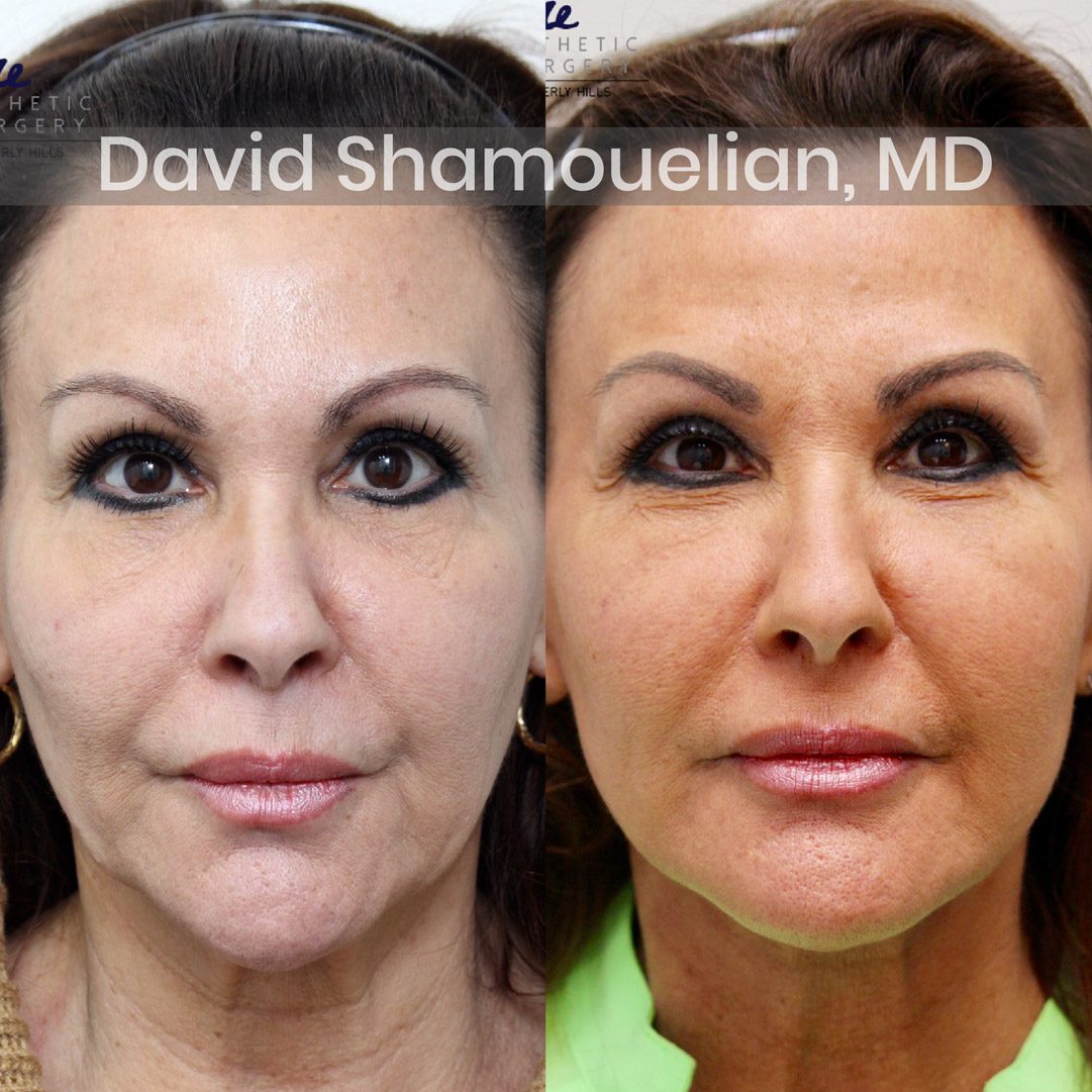 Allure-BH-Face-and-Neck-Lift-Before-After