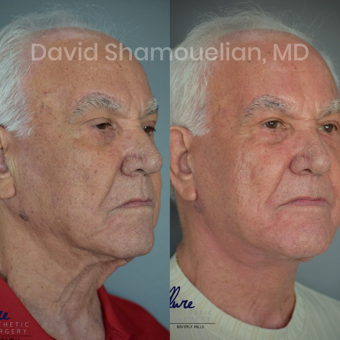 allure-bh-neck-lift-before-after