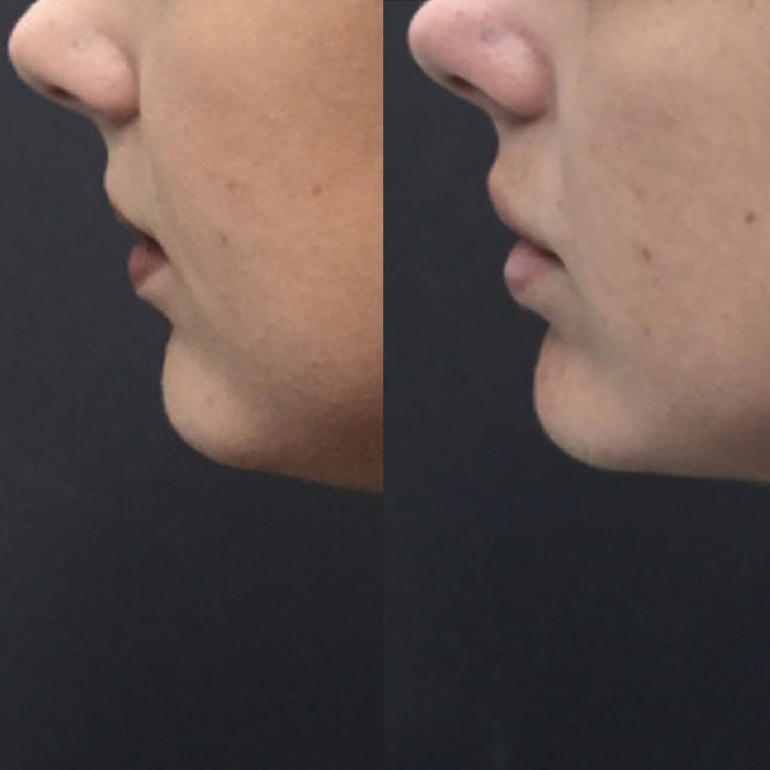 Allure-BH-Non-Surgical-Chin-Augmentation-Before-After