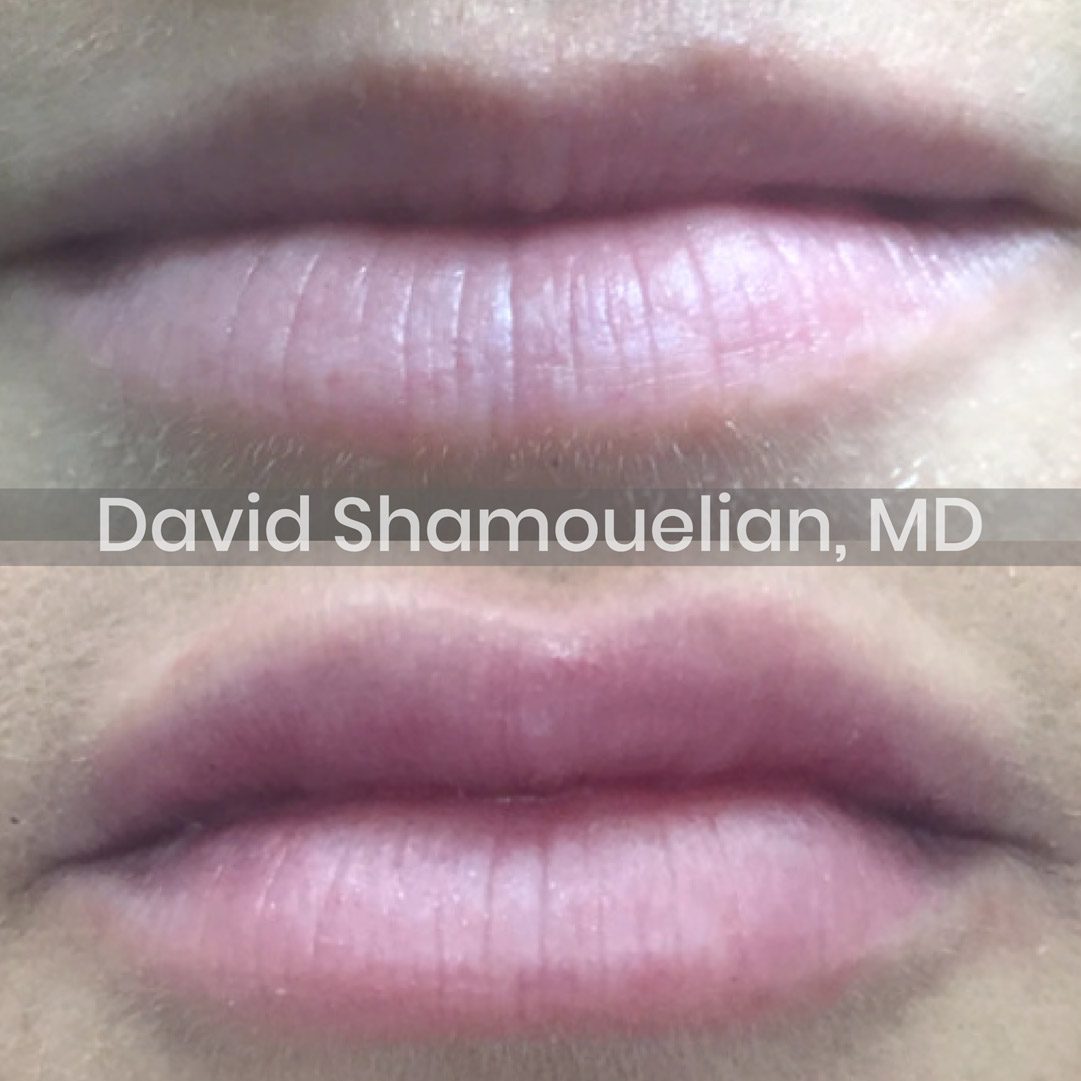 Allure-BH-Non-Surgical-Lip-Augmentation-Before-After