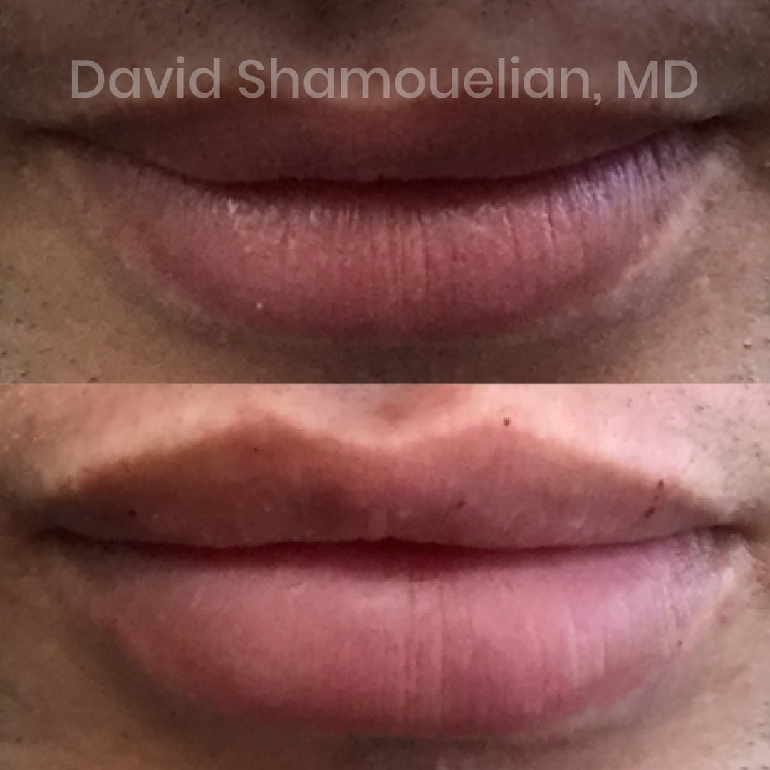non-surgical-lip-augmentation-before-after-1