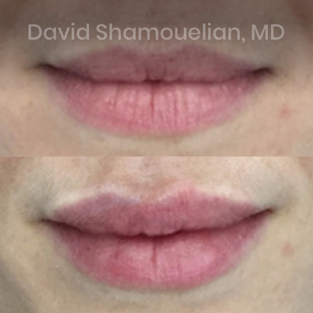 non-surgical-lip-augmentation-before-after-2