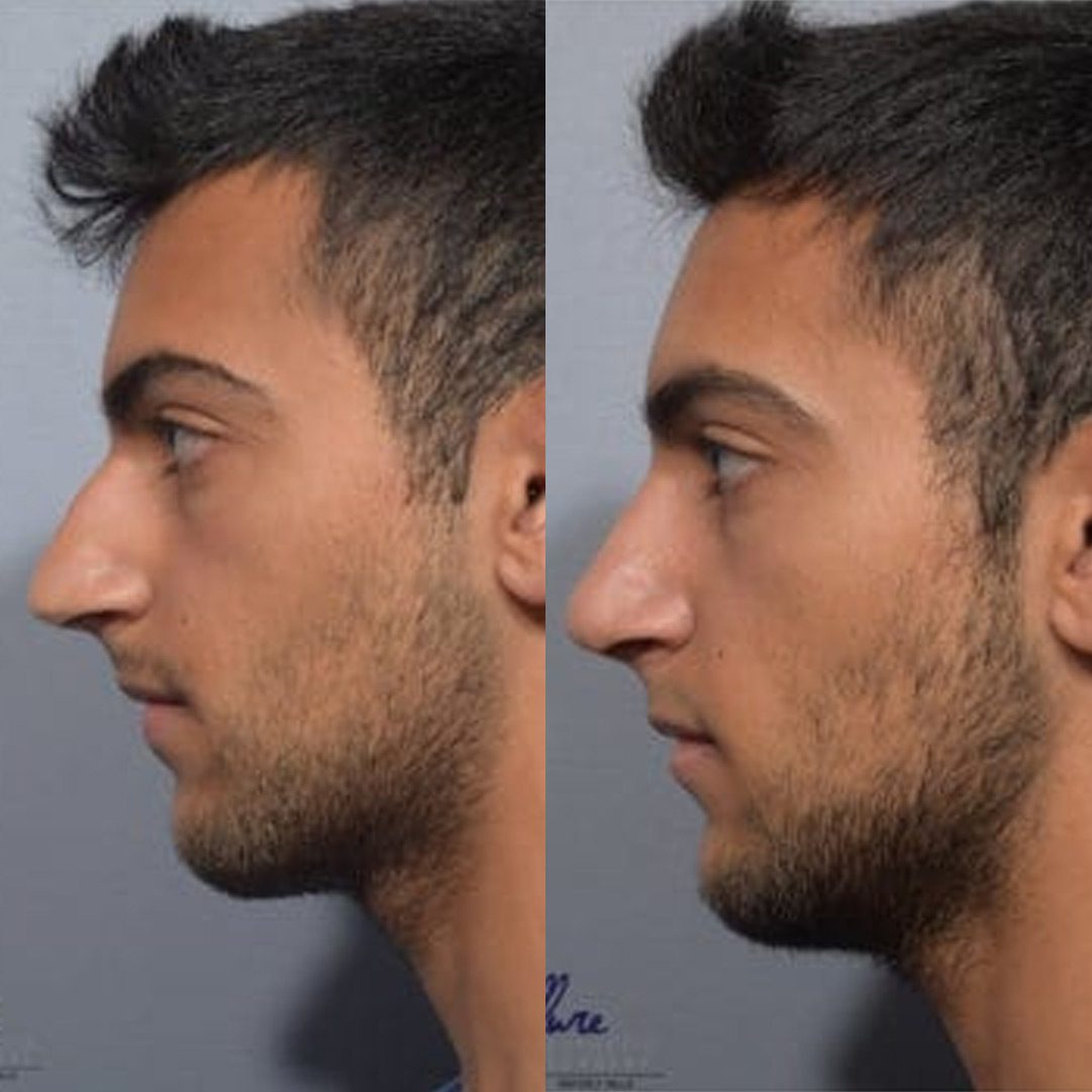 rhinoplasty-before-after