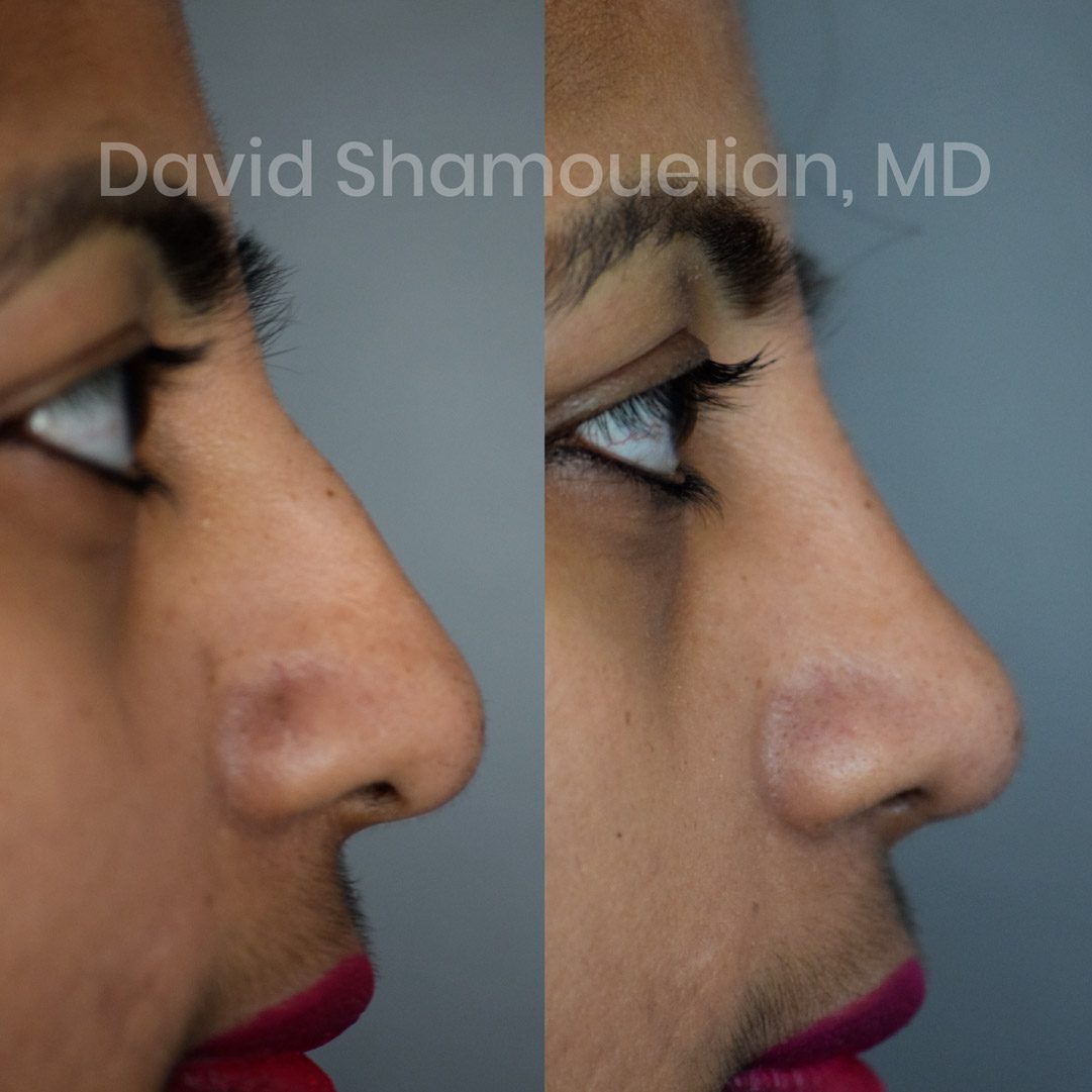 Allure-BH-Rhinoplasty-Before-After