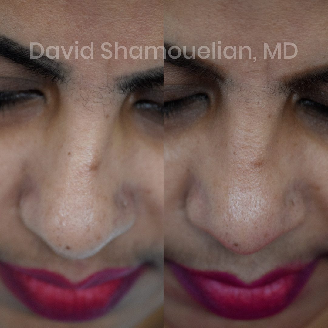 Allure-BH-Rhinoplasty-Before-After