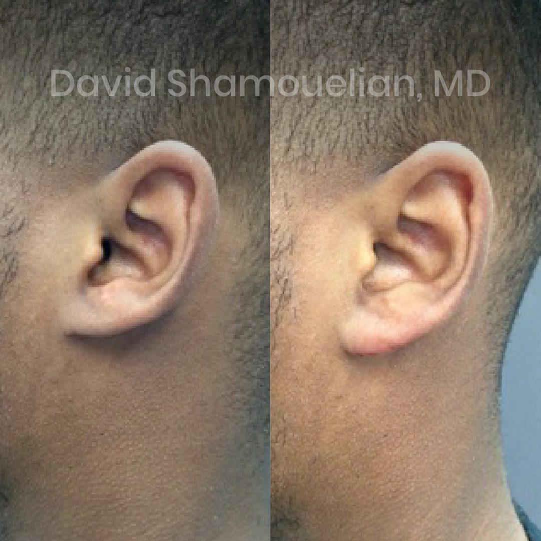 allure-bh-earlobe-repair-3-before-after