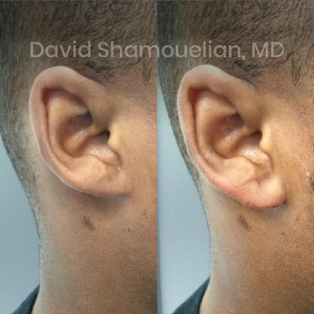 allure-bh-earlobe-repair-3-before-after