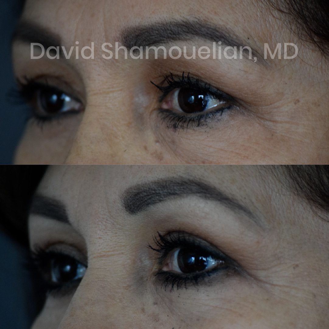 brow-lift-with-upper-eye-lid-blepharoplasty-before-after