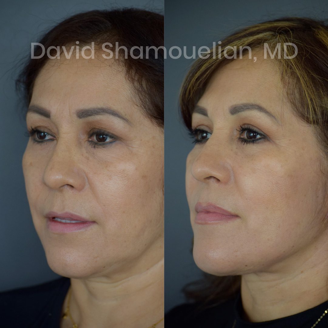 face-and-neck-lift-2-before-and-after