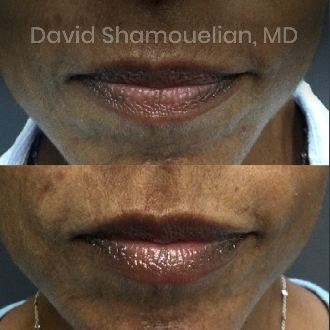 non-surgical-lip-augmentation-before-after