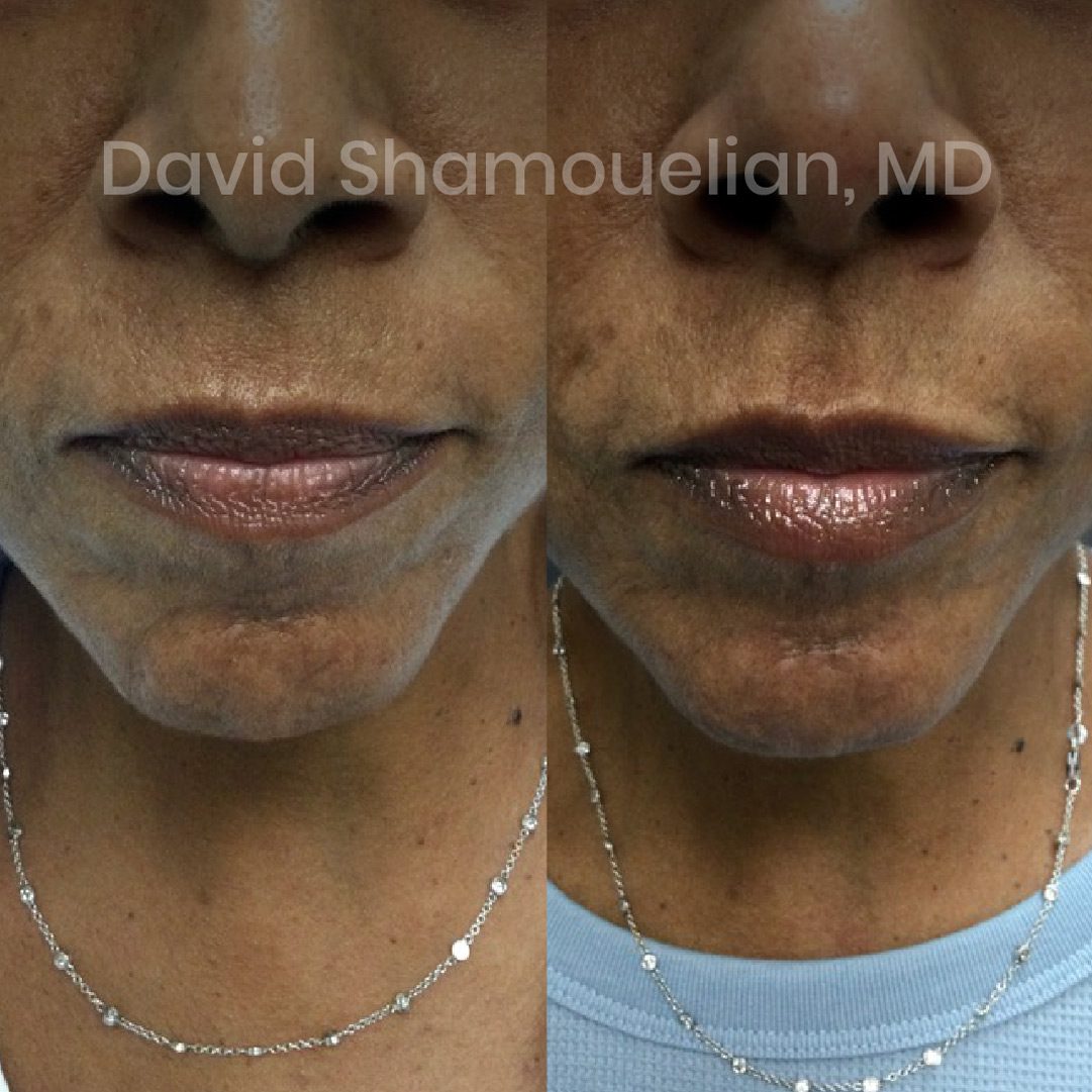 non-surgical-lip-augmentation-before-after