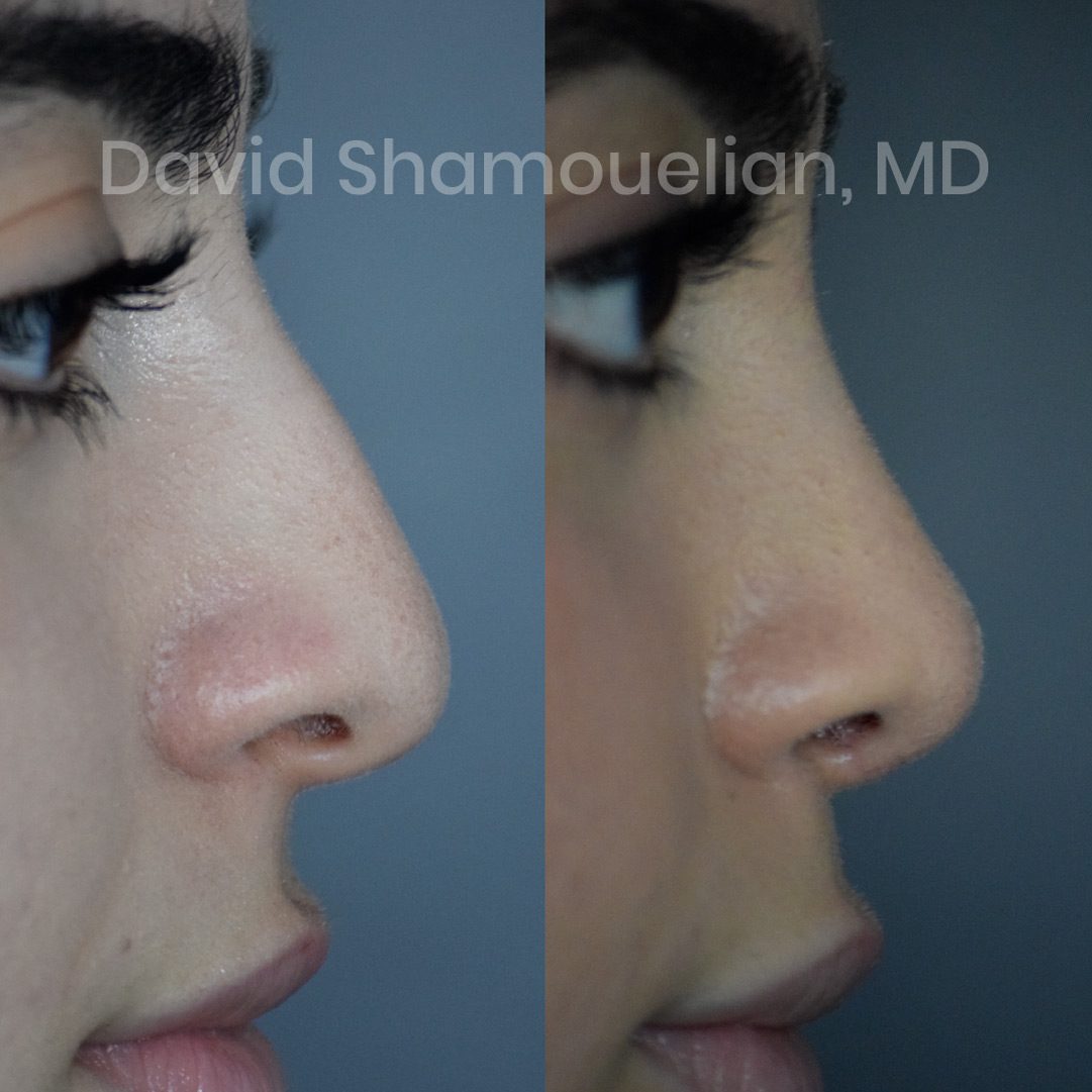 rhinoplasty-before-after-patient-23