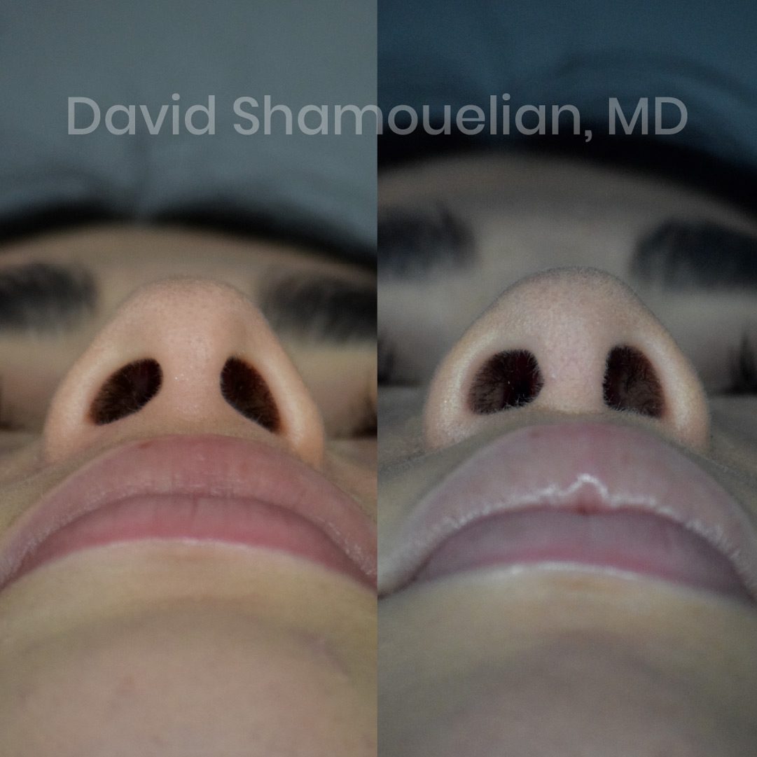 rhinoplasty-before-after-patient-23