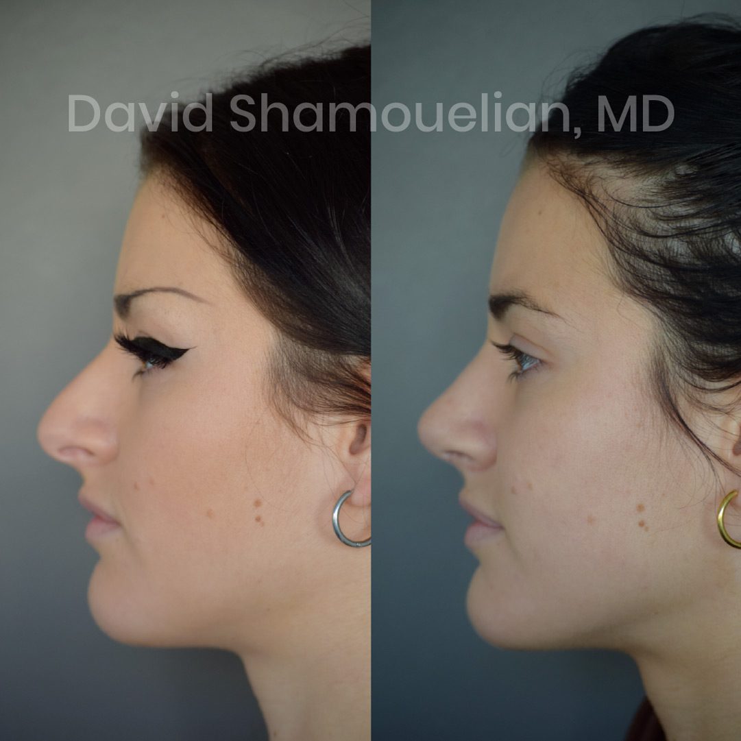 rhinoplasty-before-after-patient-24