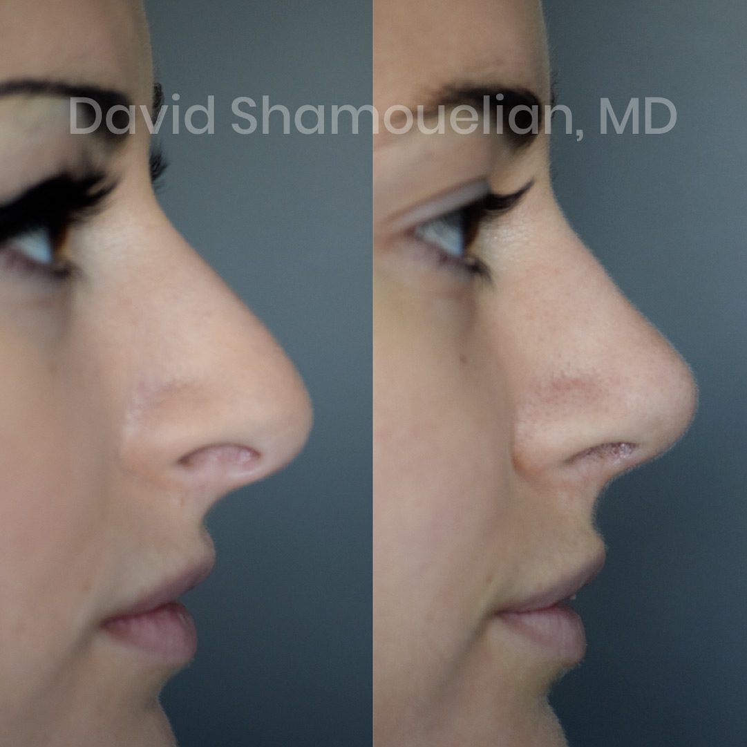 rhinoplasty-before-after-patient-24