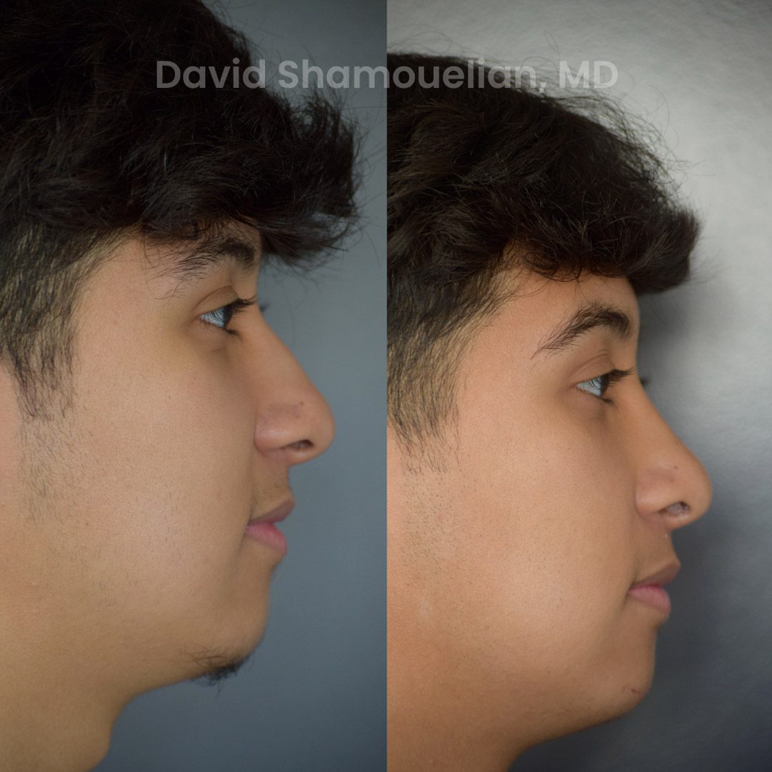 rhinoplasty-before-after-patient-25