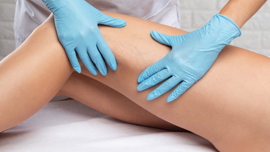 doctor-examining-patients-thigh-for-laser-vascular-reduction-treatment