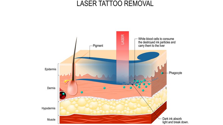 illustration-of-laser-tattoo-removal-process