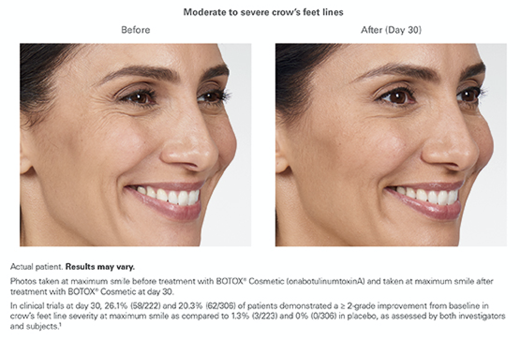 Alexandra - Botox - moderate to severe crow's feet lines - Allure Aesthetic of Beverly Hills