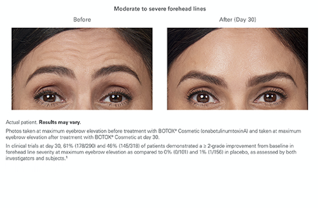 Alexandra - Botox - moderate to severe forehead lines - Allure Aesthetic of Beverly Hills