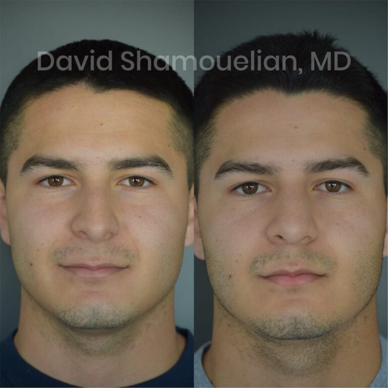 allure-bh-before-after-patient-1-image-1