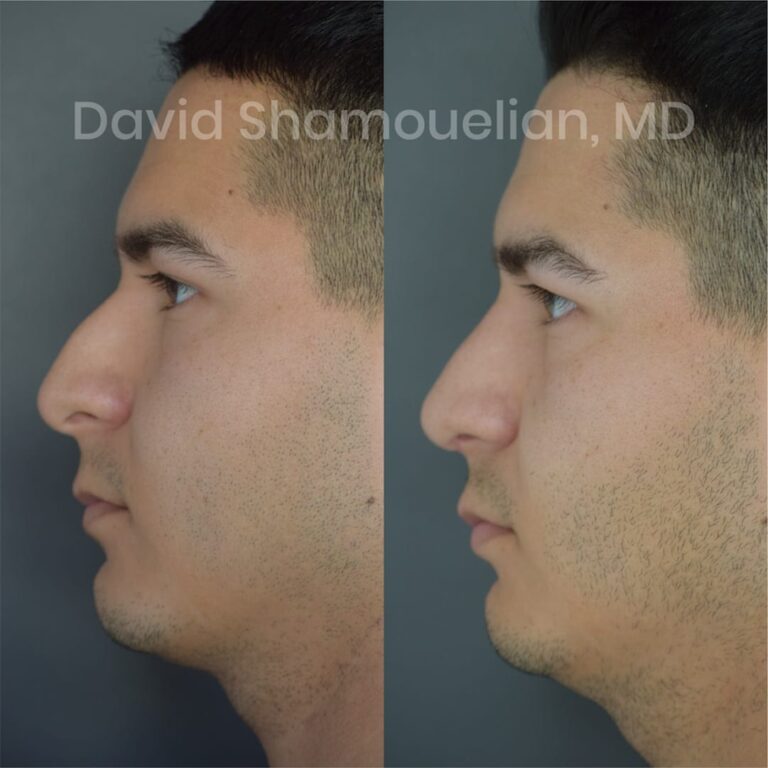 allure-bh-before-after-patient-1-image-2