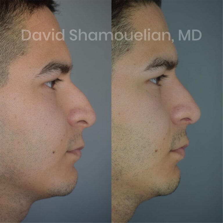 allure-bh-before-after-patient-1-image-3