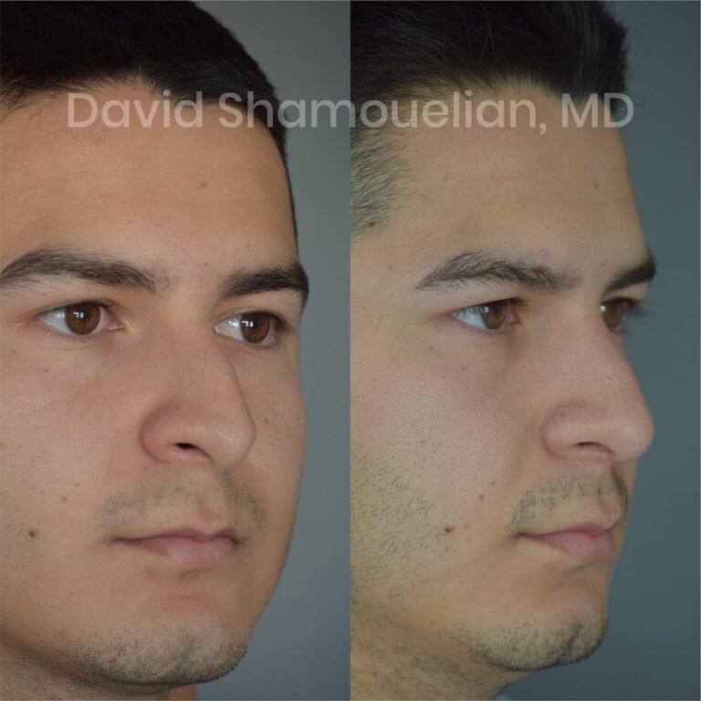 allure-bh-before-after-patient-1-image-4