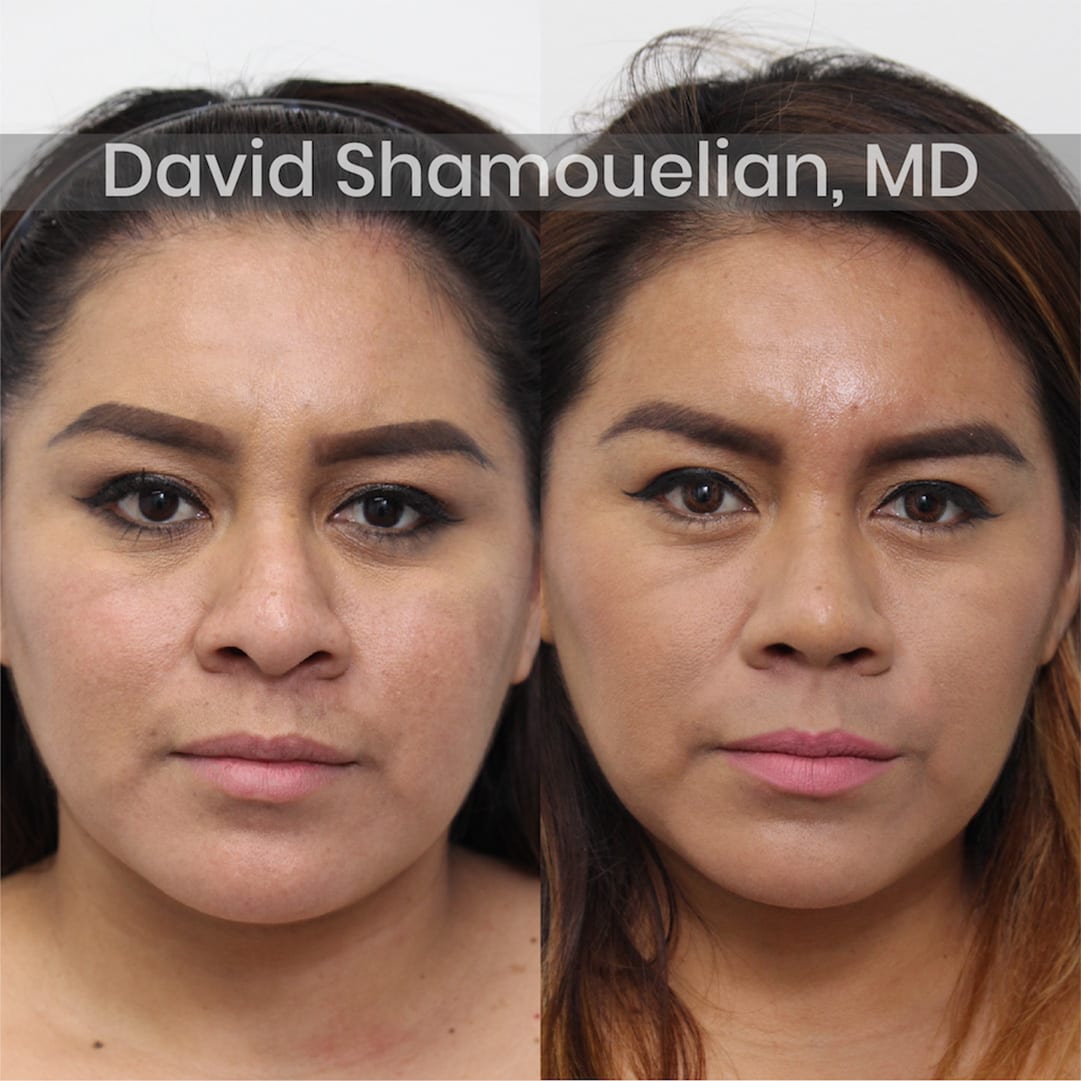 allure-bh-before-after-patient-2-image-1