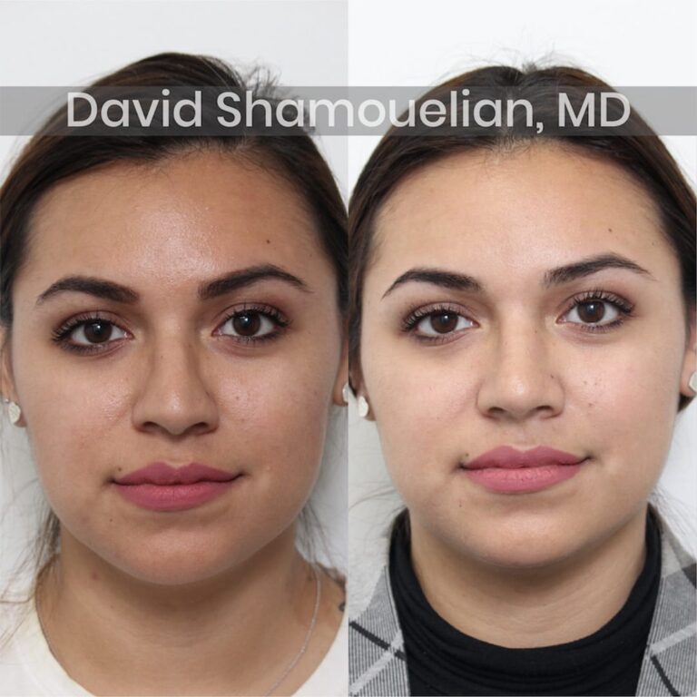 allure-bh-before-after-patient-3-image-1